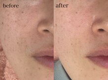 ソルシエール/毛穴×お顔そり