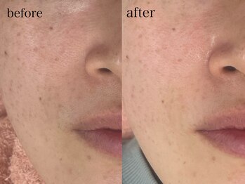 ソルシエール/毛穴×お顔そり