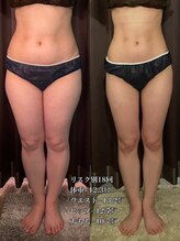 エステサロン 美飾り イオンモール木更津店/before⇒afteｒ/脂肪分解注入