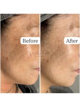 サロン ウーカ(salon WOOCA)/シミケアペン【シミ】