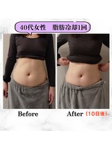 グランディールアン(GRANDIR UN)/短期間でしっかりサイズダウン