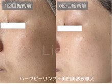 リアン/ハーブピーリング集中プログラム
