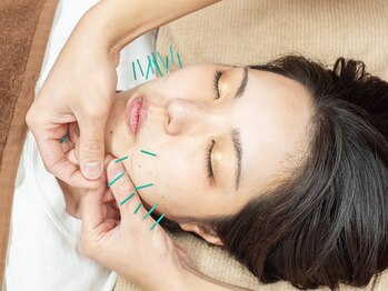 鍼灸ライフ整骨院/■美容鍼