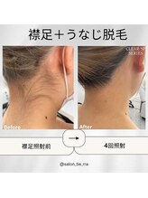 ティエラ(tierra)/襟足＋うなじ脱毛