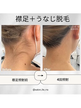 ティエラ(tierra)/襟足+うなじ脱毛