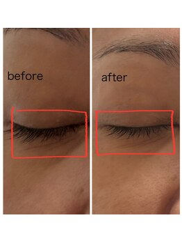 スーコ(SU:CO)/レモンボトル　目元たるみ＆しわ