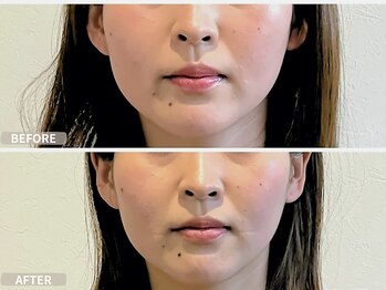 ラーナビコツ(RANA-bikotsu)/顎がカクカク鳴るかたにも!