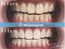 ホワイトニングカフェ 葛西店(WhiteningCafe)/☆ホワイトニング10回症例☆