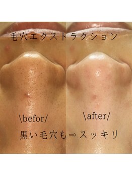 アイシェリー(eyecherie)/毛穴エクストラクション