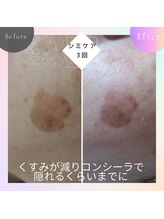 ロコモ 美容矯正サロン(Locomo)/まだまだ改善中3回目：シミケア