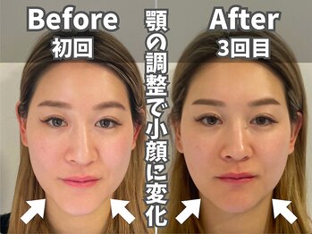 鍼灸整体院ユー(鍼灸整体院You...)/美容鍼×小顔矯正　施術後の変化