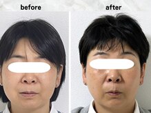 サロンスマイル/50代美容鍼ビフォーアフター