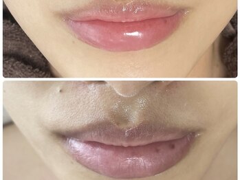 ラヴィ(Ravi)/珍しい施術！唇ケア