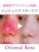 オリエンタルローザ 表参道(Oriental Rosa)/隆鼻術/鼻尖端術/鼻幅縮小術ケア