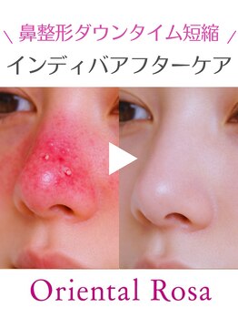 オリエンタルローザ 表参道(Oriental Rosa)/隆鼻術/鼻尖端術/鼻幅縮小術ケア