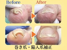 巻き爪補正店 赤羽店