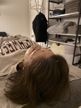 ラフテル鍼灸整骨院/エステ以上の効果◎美容鍼！