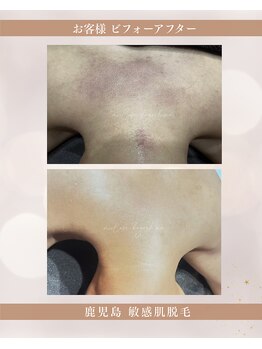 ミーラブ 鹿児島(miilove)/素肌に自信を持てる『背中脱毛』