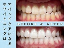 ホワイトニングショップ 浦和店/ホワイトニングビフォーアフター