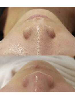 サロン ドゥ ミュゲ(Salon de Muguet)/ハイドラ毛穴洗浄