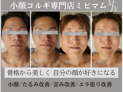 ミピマムの写真