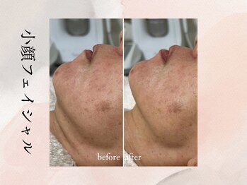 ビシア(Bicia)/小顔フェイシャル