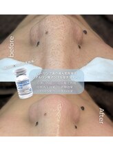 リ クリニカル ラボ(Re clinical Labo)/選べる！2種類のピーリング