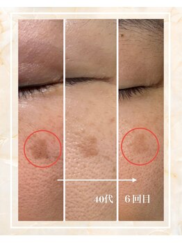 サロンルナ(Salon Luna)/40代　6回目