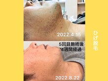 エクレ 柏店(EKURE)/ヒゲ脱毛