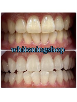 ホワイトニングショップ 栃木佐野店/Before→After 