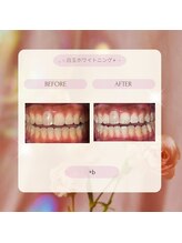 プラスビーセルフ(+b self)/ホワイトニングビフォーアフター