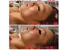 シャルム 鹿児島店(ChaRme)の雰囲気（【セルラム】フェイスラインがかなりスッキリされました！）