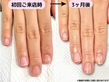 カピリナ(Ka Pilina)/自爪育成・川崎・深爪