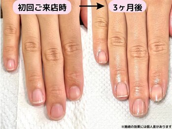 カピリナ(Ka Pilina)/自爪育成・川崎・深爪