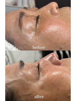 テンディ(TenD.)/シワ改善