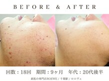 ロエヴェ(ROEWE)/ニキビ改善・毛穴ケア・肌質改善