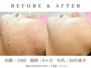 ロエヴェ(ROEWE)/ニキビ改善・毛穴ケア・肌質改善
