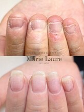 マリーロール 梅田店(Marie Laure)/深爪矯正/自爪育成/自爪風