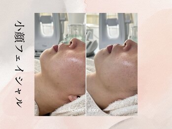 ビシア(Bicia)/小顔フェイシャル