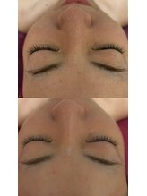 ビューティーサロン アンジェリーク/REVI　before→after &nbsp;