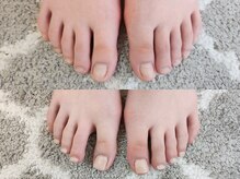 グラシナ なんば店/深爪/自爪育成/フィルイン