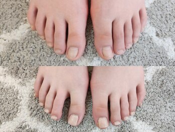 グラシナ なんば店/深爪/自爪育成/フィルイン