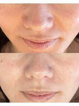 ボタニック 福津店(BoTANiC)/【ハーブピーリング】16回／20代