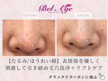 ベル アージュ/毛穴洗浄フェイシャル