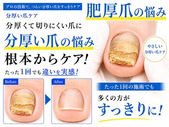 フットブルー 青山店の写真/【表参道駅2分】創業1998年 巻き爪世界大会採用の特許取得ワイヤーによる矯正技術（分厚い爪・肥厚爪対応）