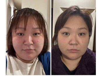 ハーボプラス(THE HEARBO plus)/施術例6