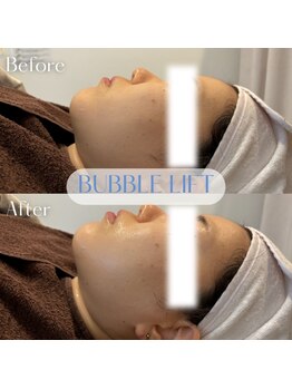 バブルビューティー(Bubble beauty)/LDM水玉リフティング