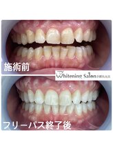 ホワイトニングサロン 京都烏丸店/ホワイトニング施術例