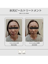 アンジュロワール/水光ピールトリートメント