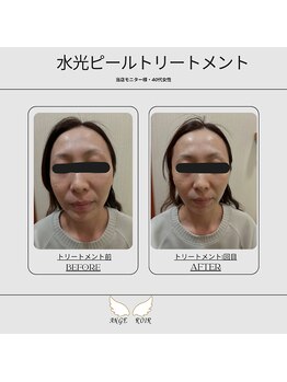 アンジュロワール/水光ピールトリートメント